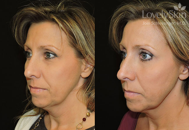 Kybella Before & After Photos | Skin Specialists P.C.