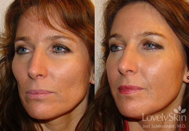 Omaha Cosmetic Surgery Juvederm Skin Specialists Pc