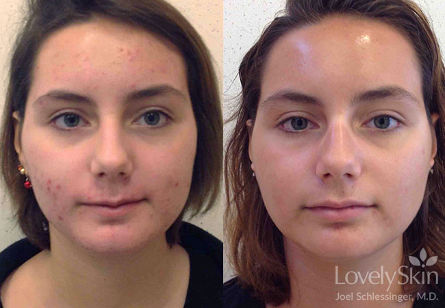 Acne Before &amp; After Photos | Skin Specialists P.C.