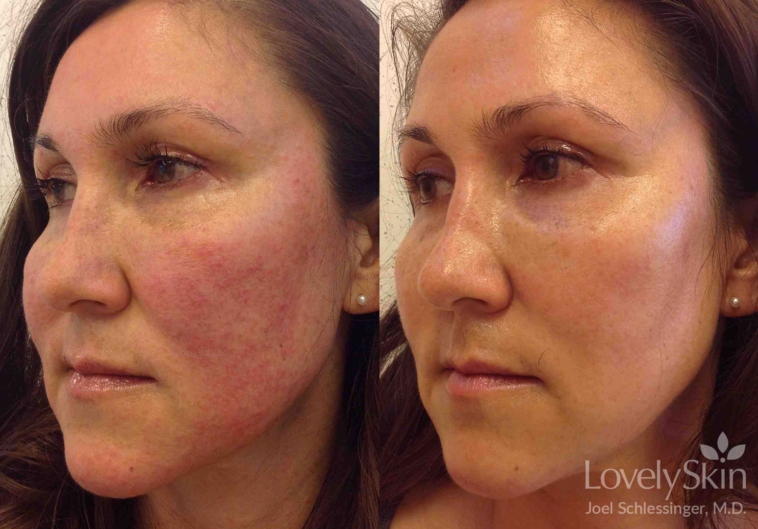 Rosacea Before And After Photos Skin Specialists Pc 