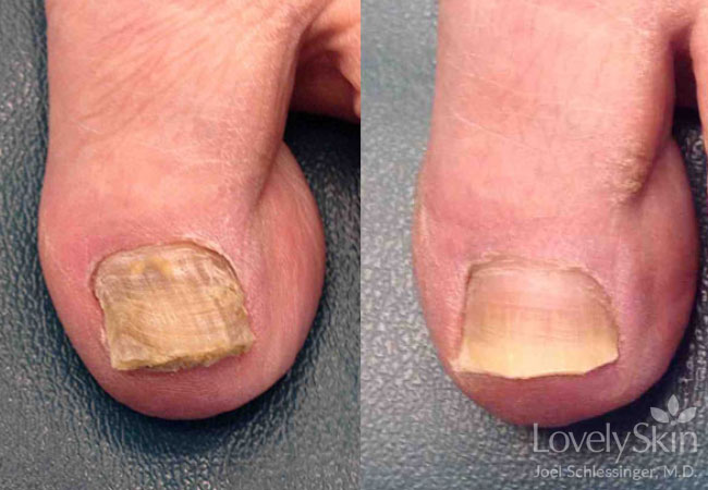 Toenail Fungus Before &amp; After Photos | Skin Specialists