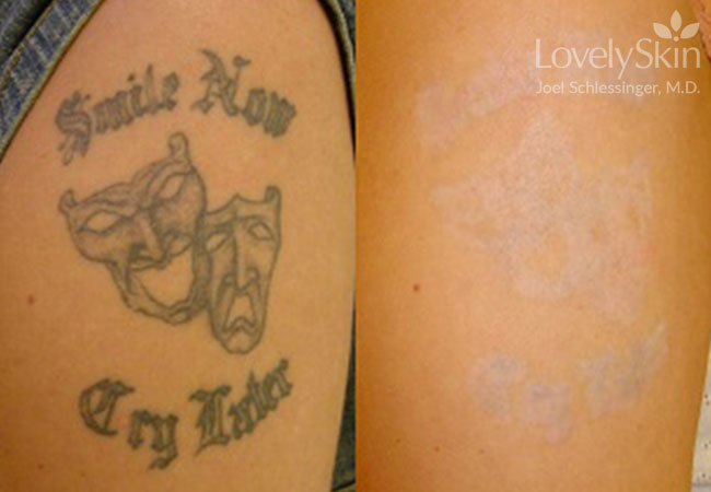 Tattoo Removal Before &amp; After | Skin Specialists P.C.