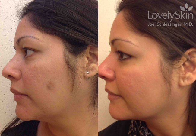 Facial Mole Removal Photos 34