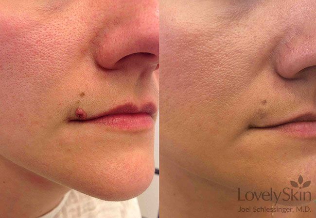 omaha-cosmetic-dermatology-mole-removal-skin-specialists-pc