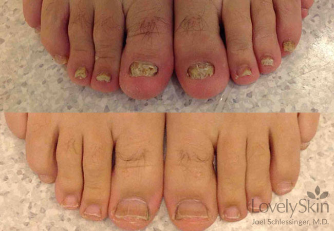 toenail-fungus-before-after-photos-skin-specialists