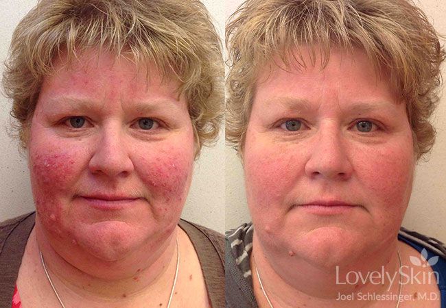 Rosacea Before And After Photos Skin Specialists P C