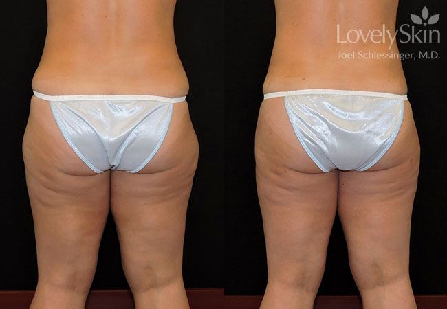 How does Smart Lipo surgery differ from regular liposuction?