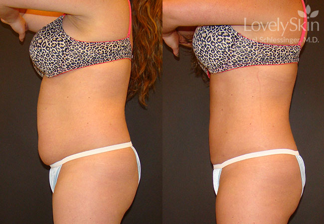 Omaha Cosmetic Surgery Smartlipo Treatment Skin Specialists Pc