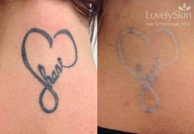 Omaha Cosmetic Surgery - Tattoo Removal | Skin Specialists PC