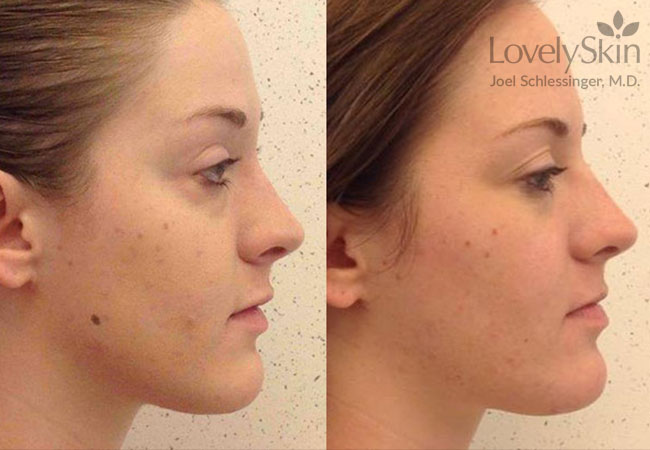 Mole Removal Before and After Photos